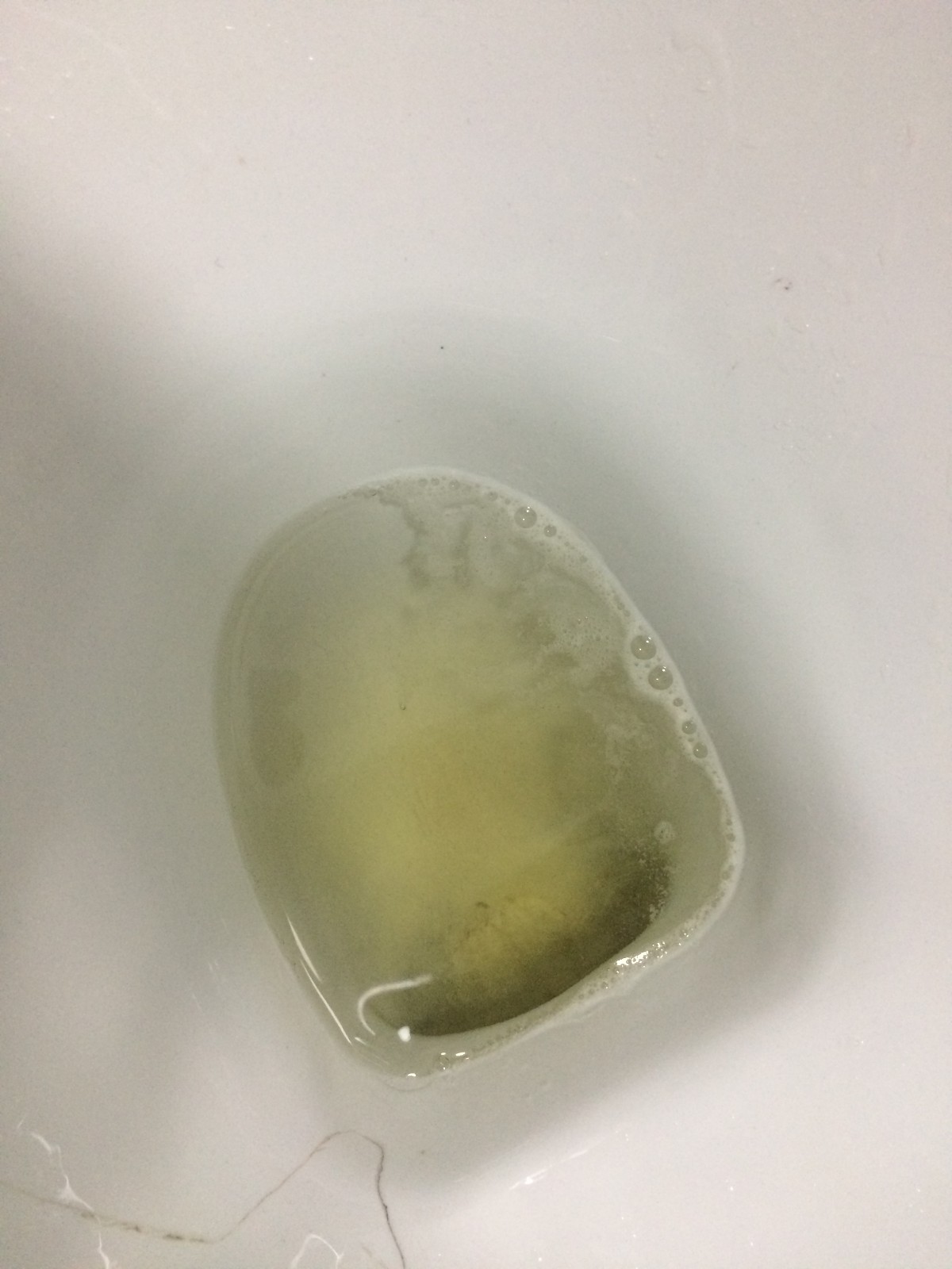 尿里有泡沫是怎么回事？是肾出问题了吗？