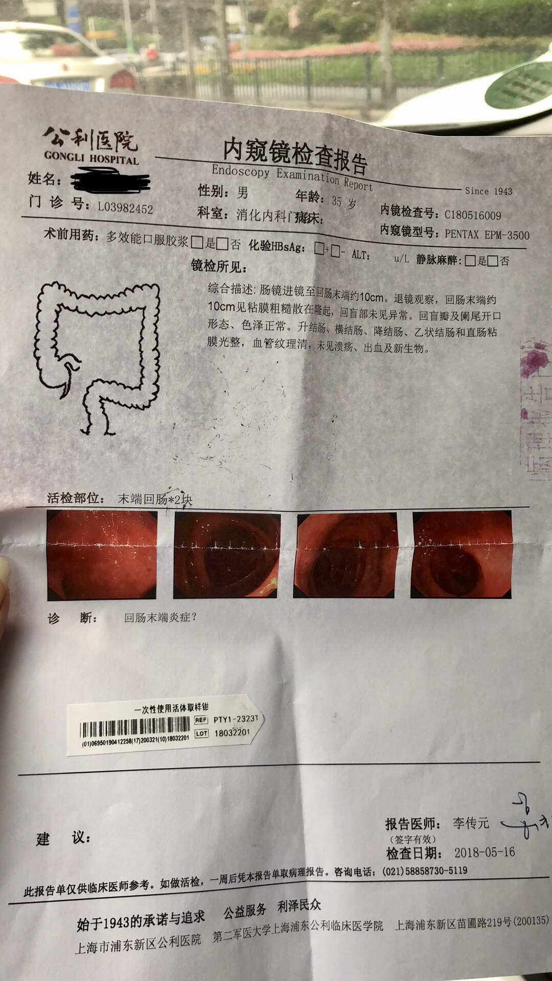 肠镜查出有腺瘤