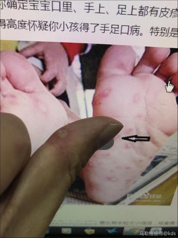 我竟然得手足口了