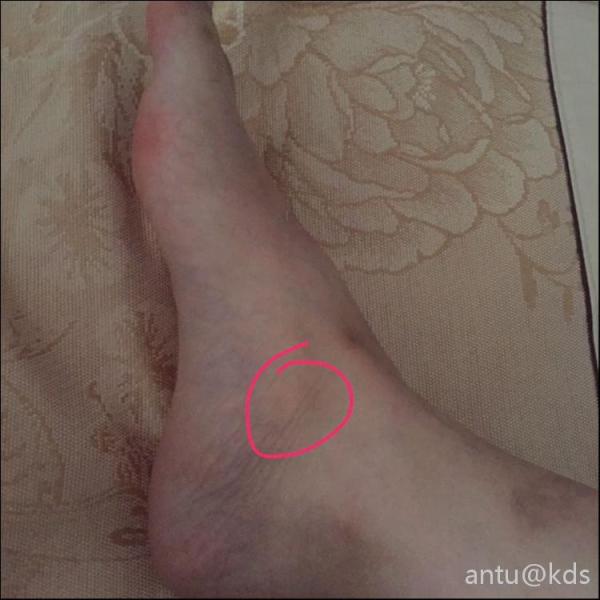 脚扭伤后遗症,骨头凸出来,走路酸胀怎么办?