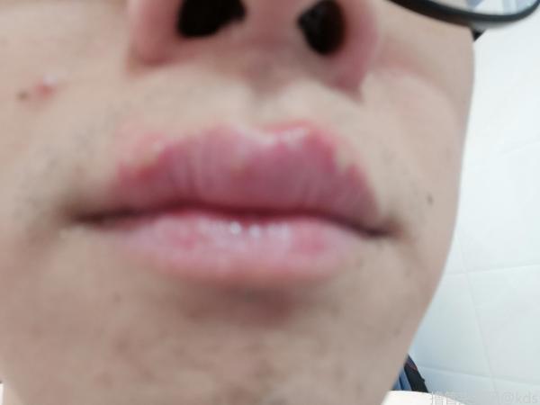 每年冬天都会这样,难受不说,很吓人,上火,缺少维生素,遗传,完全不知道
