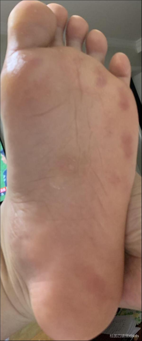 脚上的红斑是什么情况?