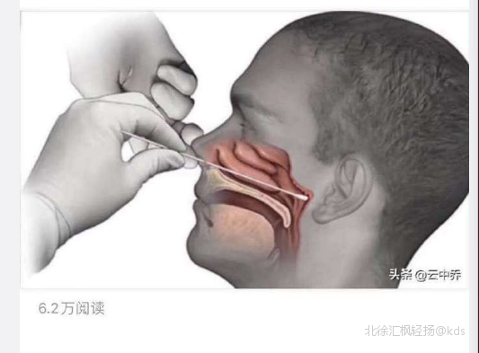 鼻咽拭子原来是这么做的吓人