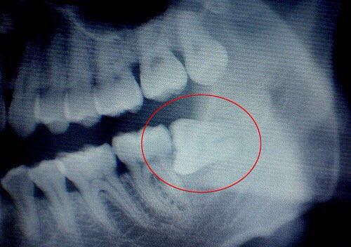 上次顺利拔完上智齿,而这次下智齿也开始痛了
