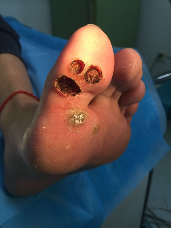 手指上寻常疣怎么办?