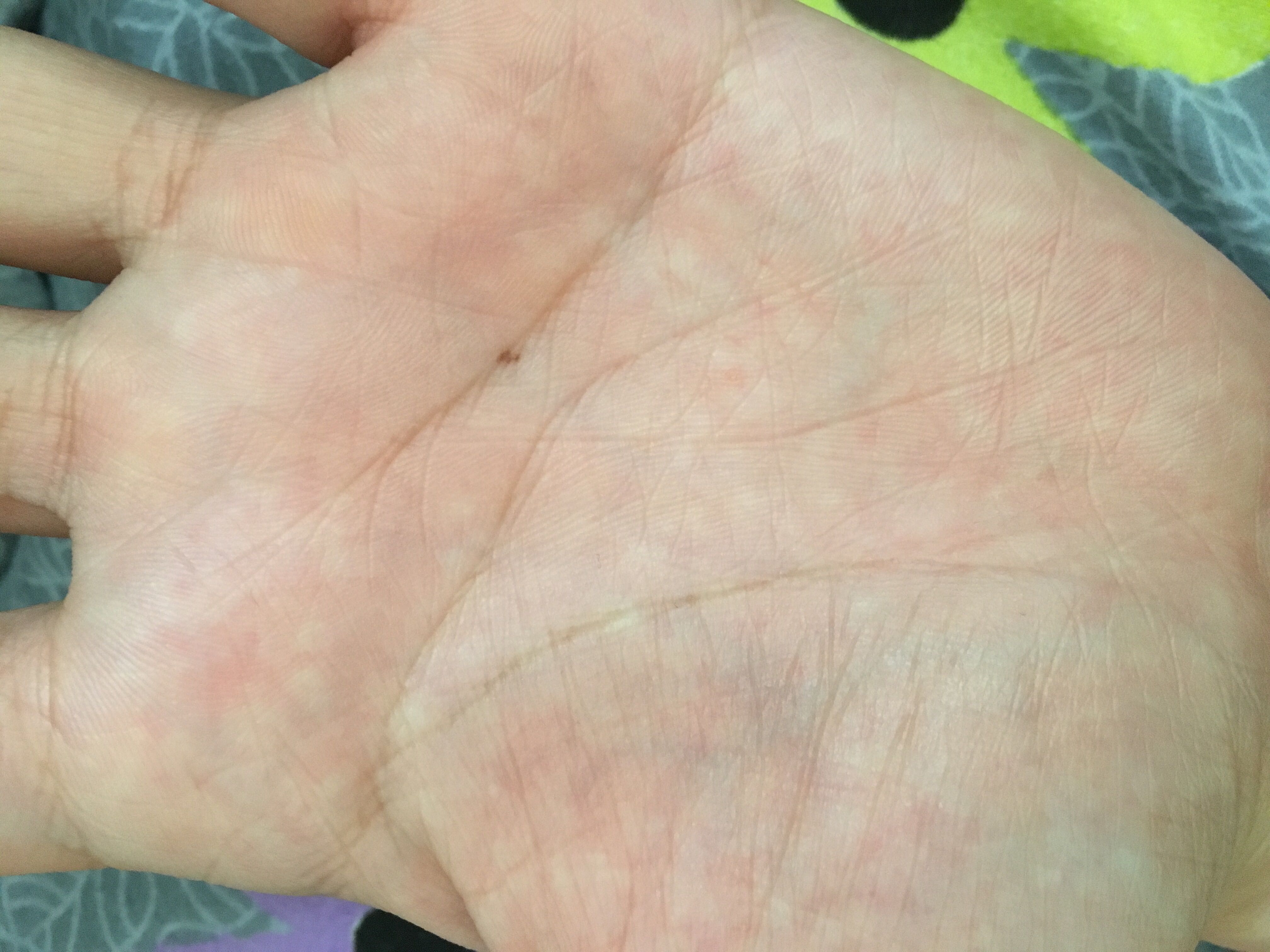 主题:[iphone]手掌心突然长了颗黑痣,撒情况?