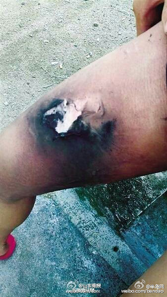 17岁小伙骑电动车途中 小米手机突然爆炸烧伤大腿