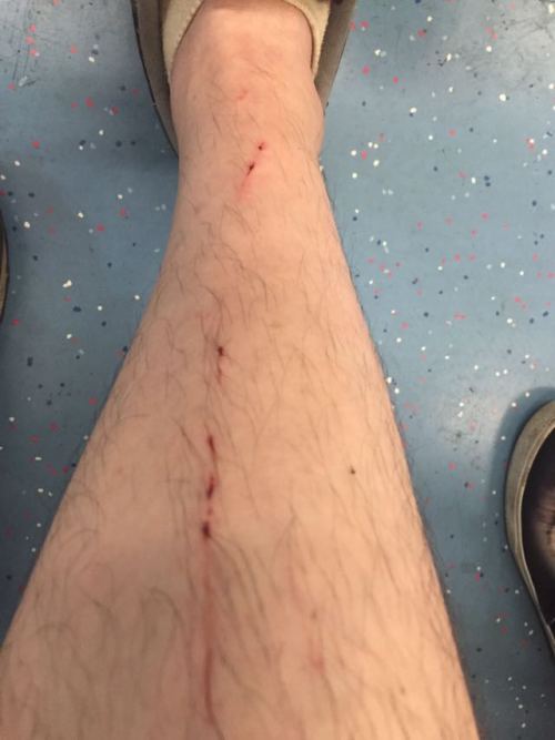 星期天腿被野猫咬了,腿到今天还肿着