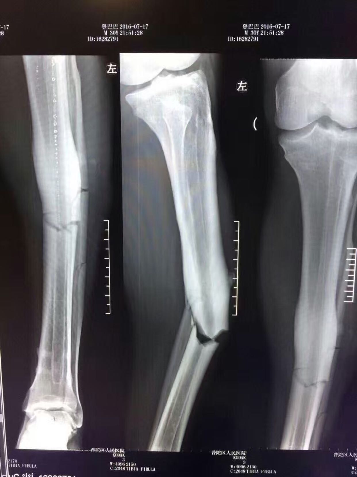 主题:《〈〈导致登巴巴断腿,你觉得孙祥是故意的吗〉〉》