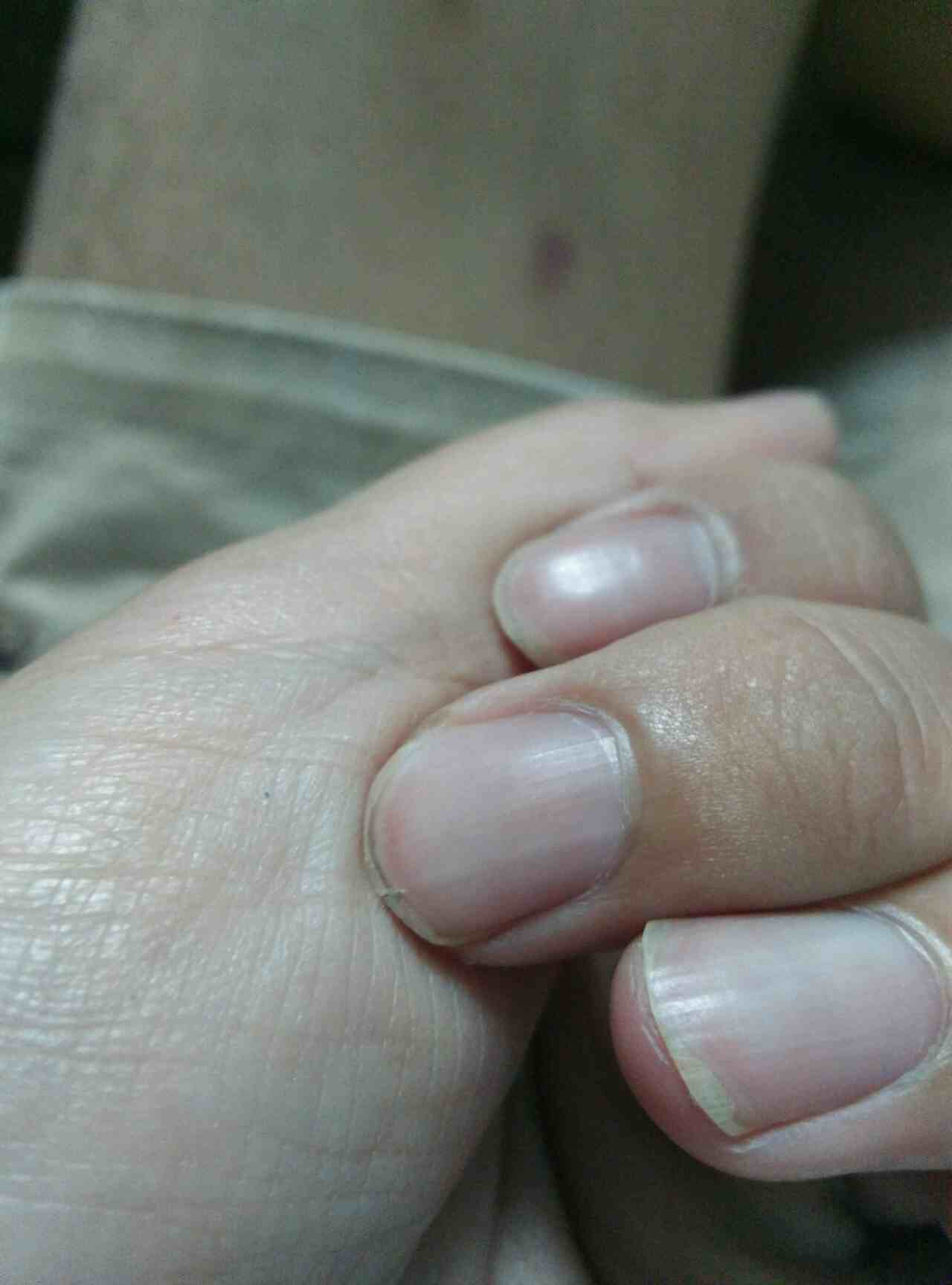 这两年手指甲出现一条线并且开裂