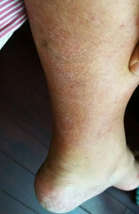 舅舅的左小腿是什么皮肤病