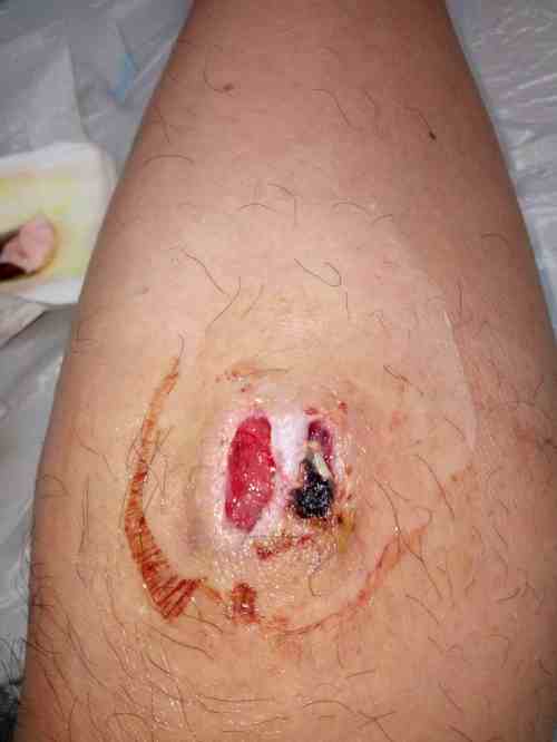 最后伤口是一个红色的伤疤,上面没有皮,伤口的横切面能看到红色的肉