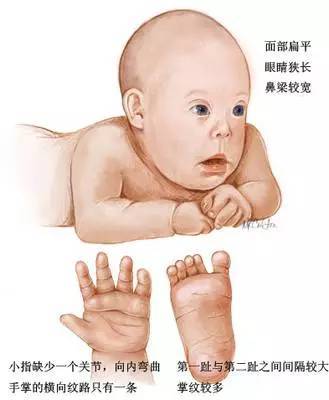 唐宝宝婴儿时期的表现图片