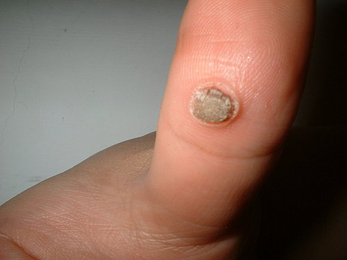 杀瘊子比挤痘子爽多了,辣辣叫杀根