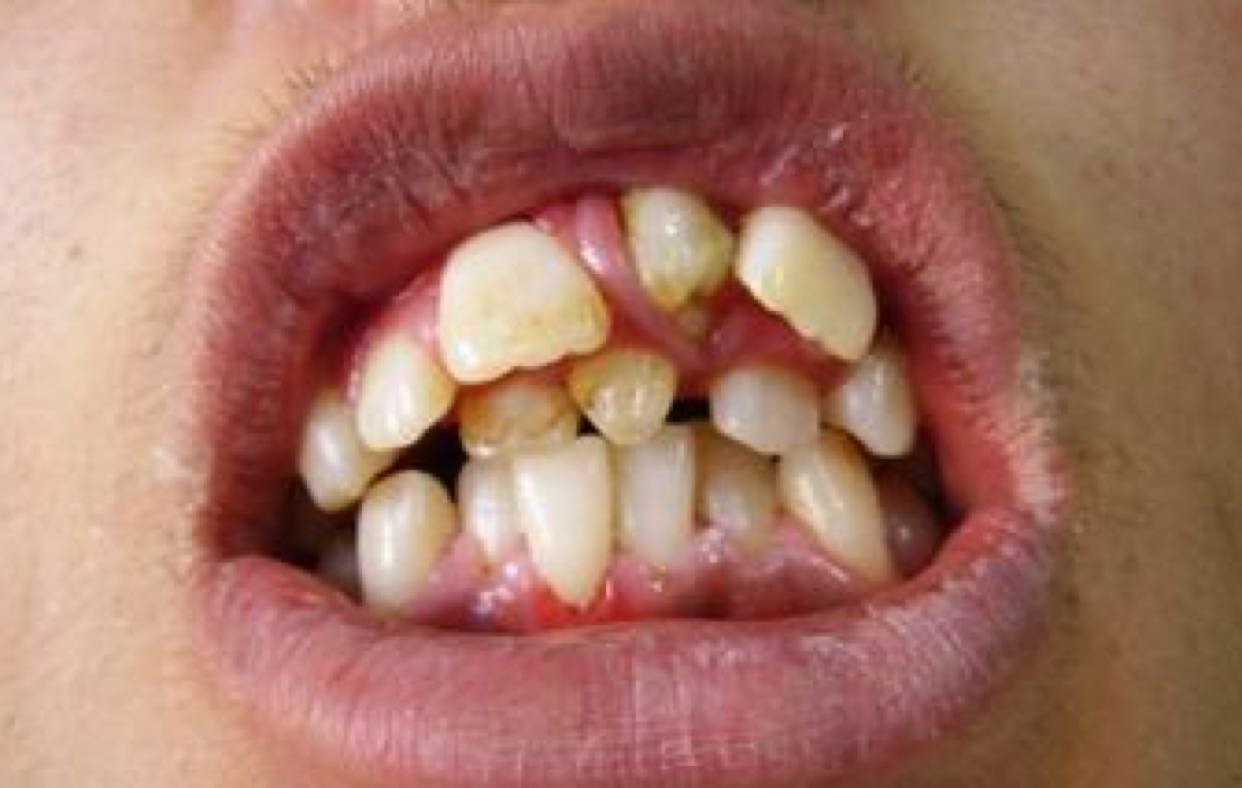 女人牙齿像鬼牙图片