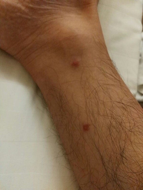 脚上红点是怎么回事?