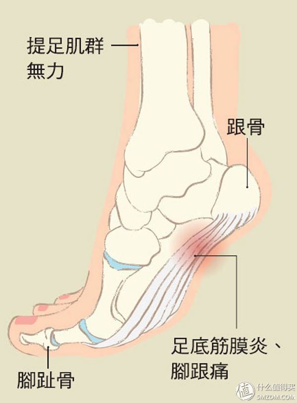 足底筋膜炎4个痛点图片