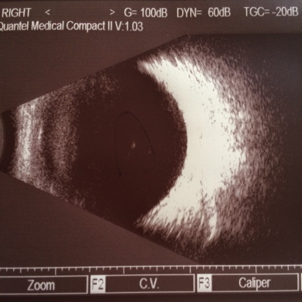 飞蚊症,晶状体混浊