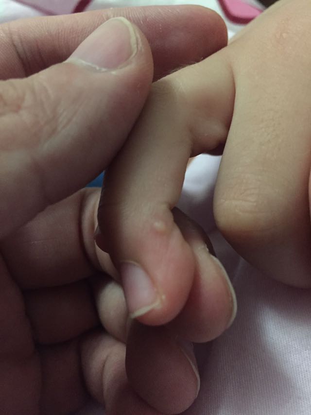 小孩手指腱鞘囊肿图片图片