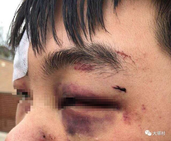 中国留学生在澳洲被打成猪头