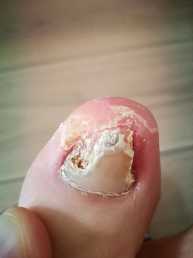 左边脚趾也是这样自己恢复的.