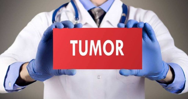 1,良性2,交界性 3,恶性 &nbs;&nbs; (恶性的肿瘤我们就叫cancer,即