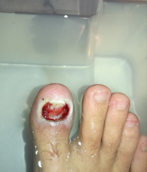 之前甲沟炎复发过几次,今天狠下心去医院把指甲拔了