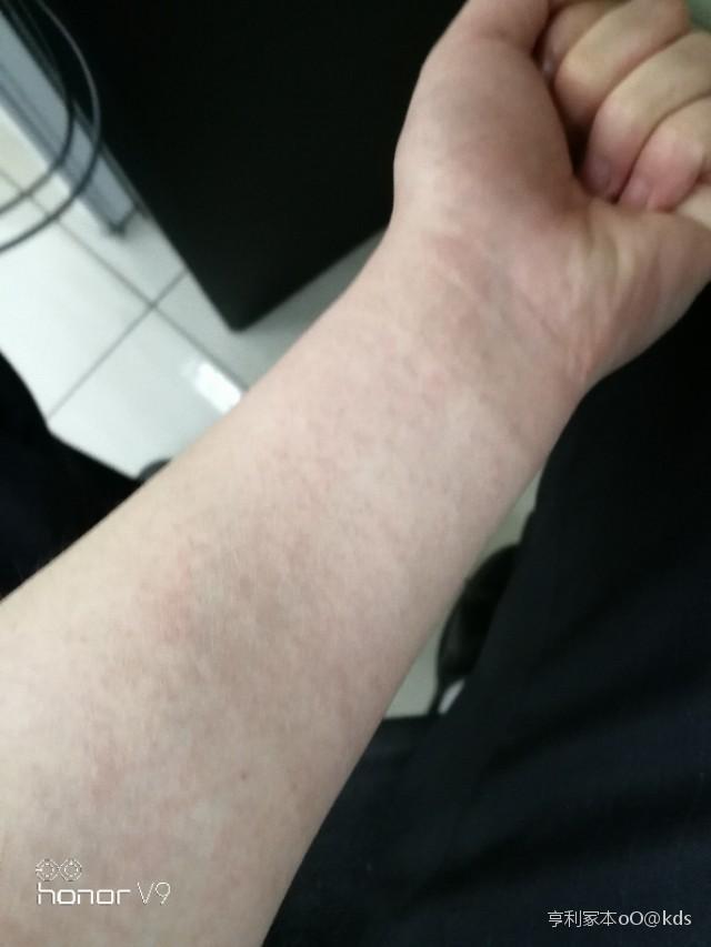 求助不知道吃了撒,过敏了