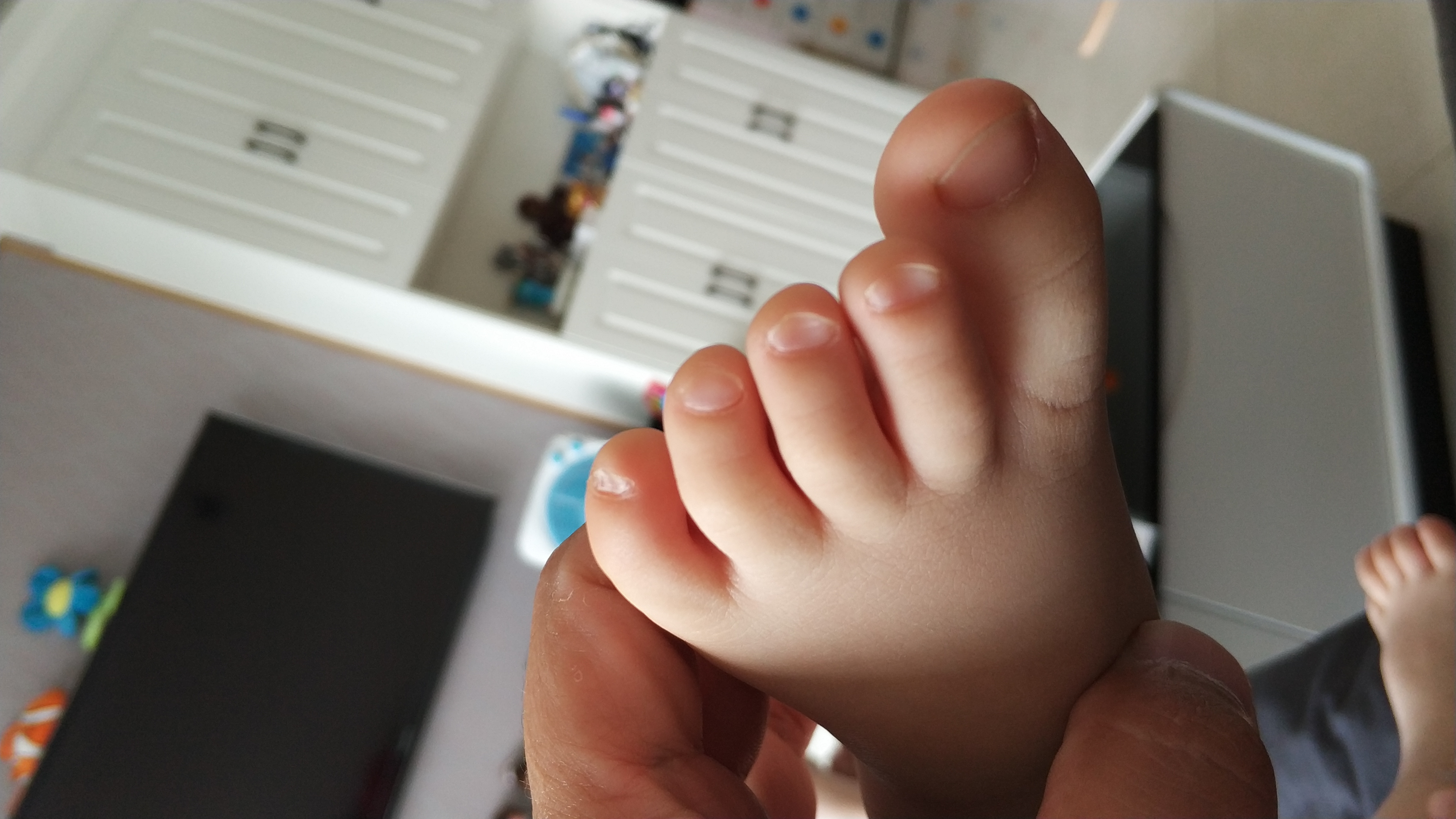 kds 宽带山 儿子最近脚趾甲凹进去 是缺微量元素