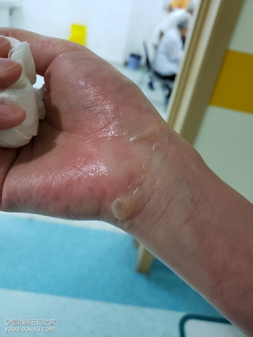 炸年糕忽然爆炸胸口三级烫伤