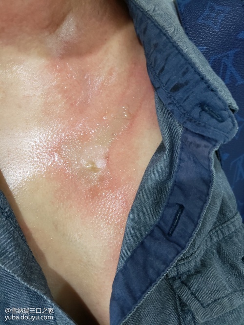 炸年糕忽然爆炸胸口三级烫伤