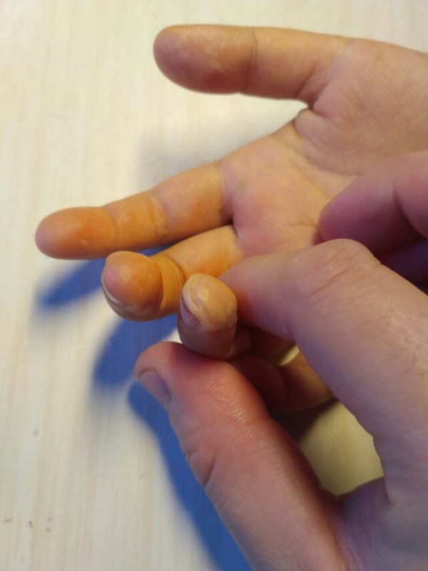 求助:8岁小孩手指脱皮怎么回事?