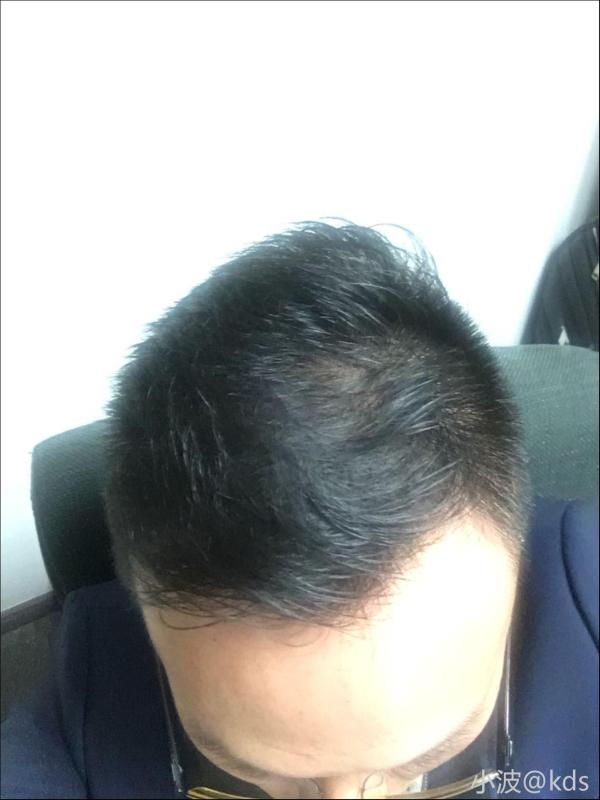 30岁,两额头发已经秃成这样,怎么办?