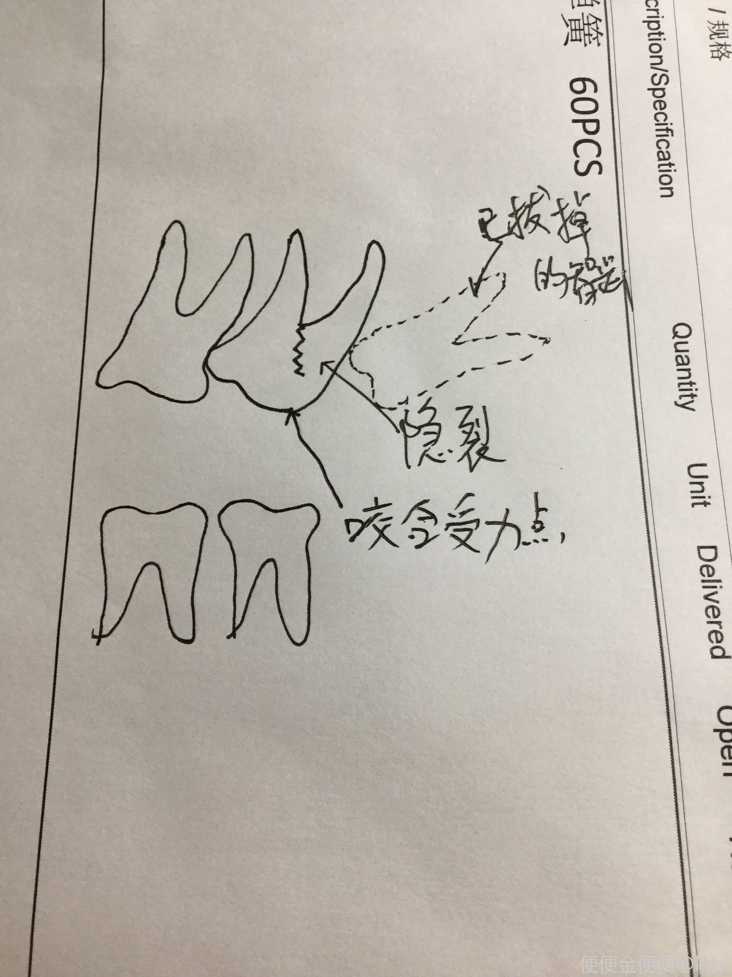 第二磨牙拔掉了,一定要種植牙嗎?