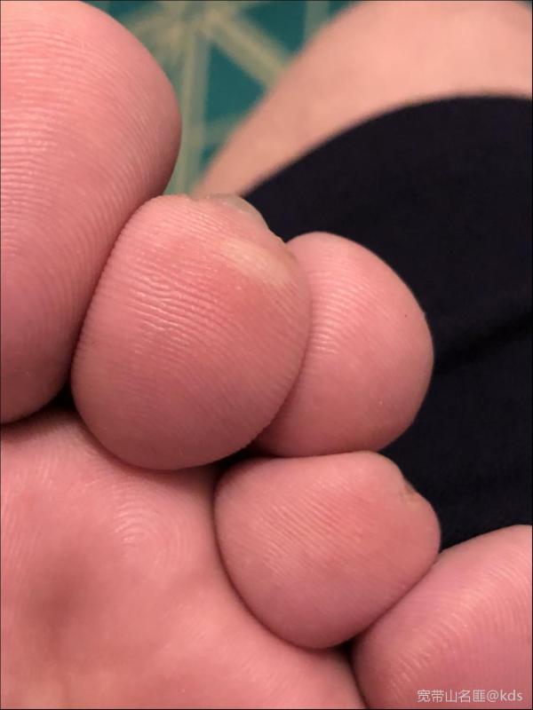 蚊子块咬在哪个部位最难受?