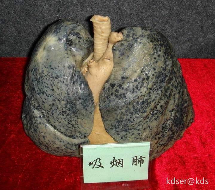 看到身边太多悲惨的例子,决定在kds做禁烟大使