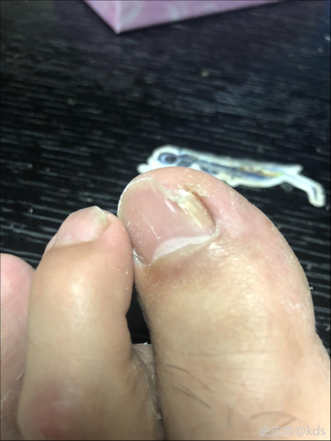 灰趾甲怎么治疗?