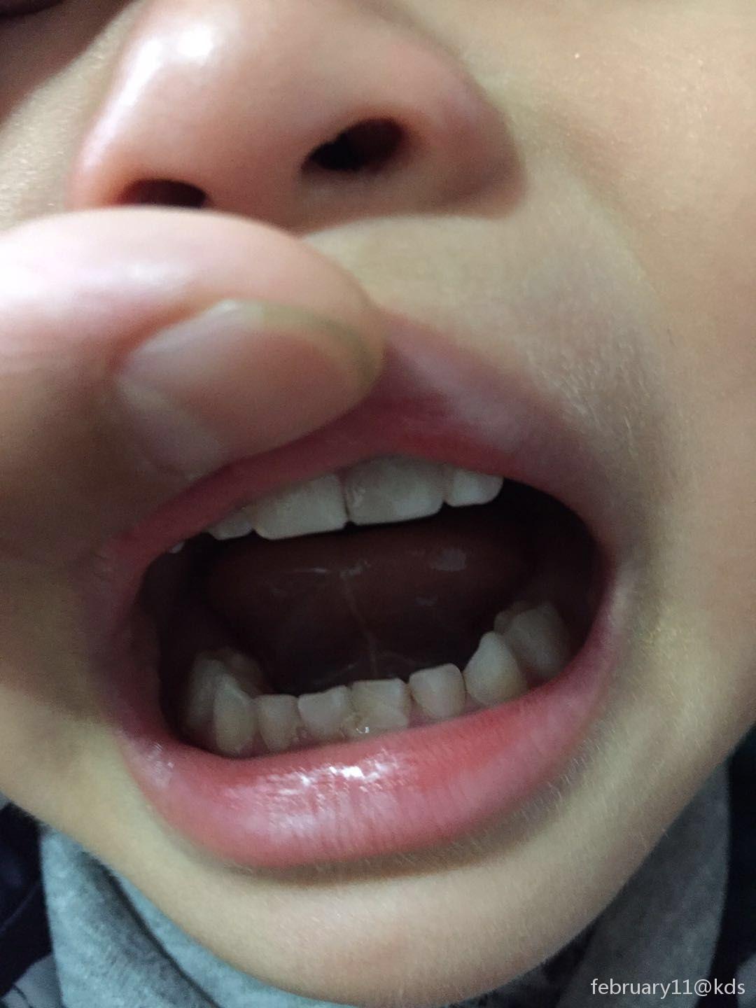 宝宝乳牙门牙腐蚀照片图片