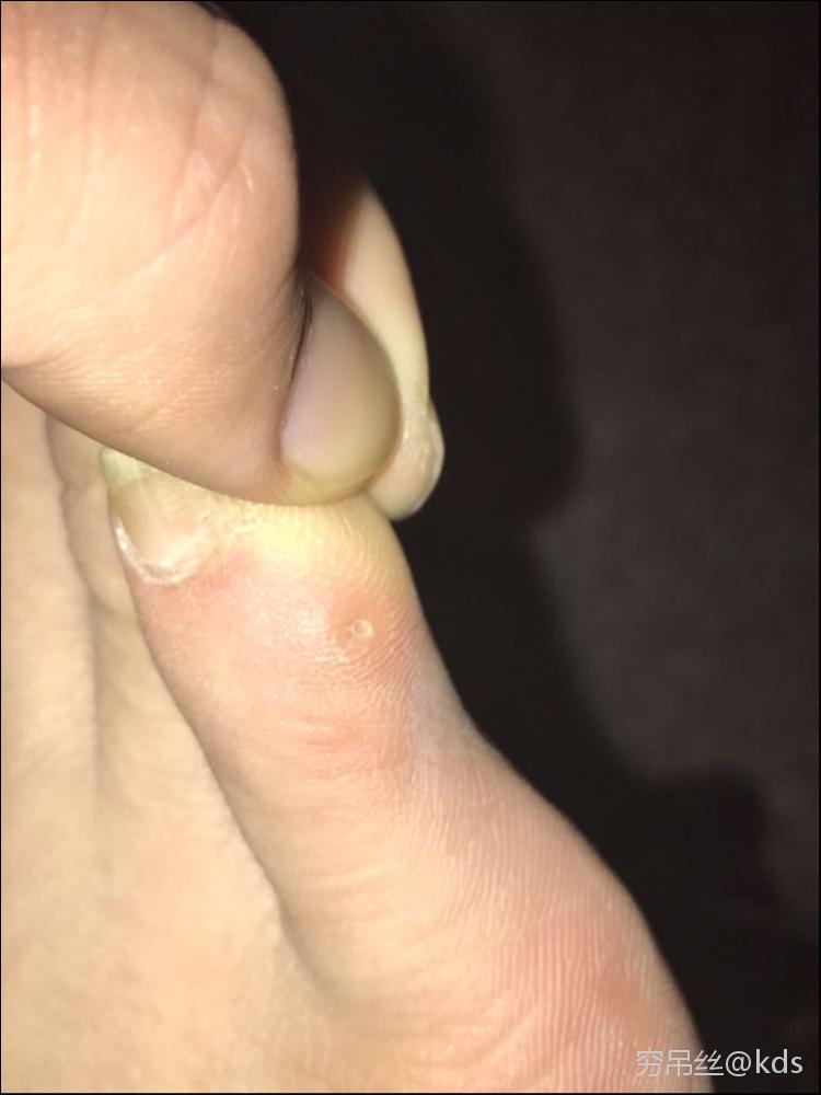 鸡眼需要开刀吗?