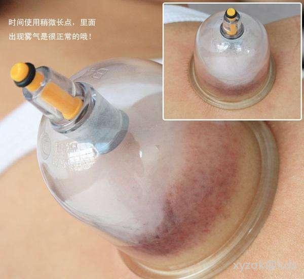 拔气罐拔成这样正常吗