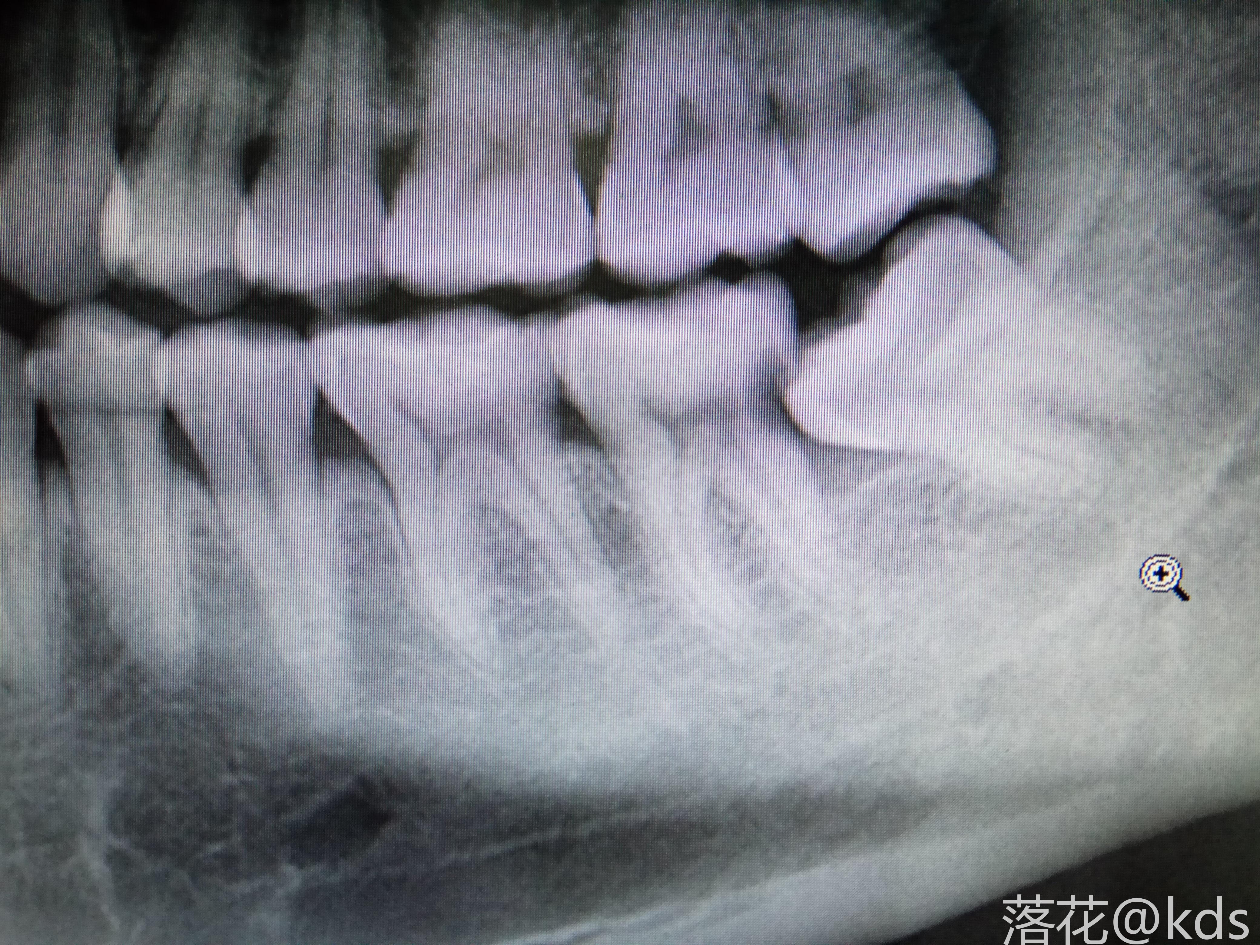 图是拔智齿前的片子,智齿年前已经拔了,现在需要治疗一下旁边的那颗