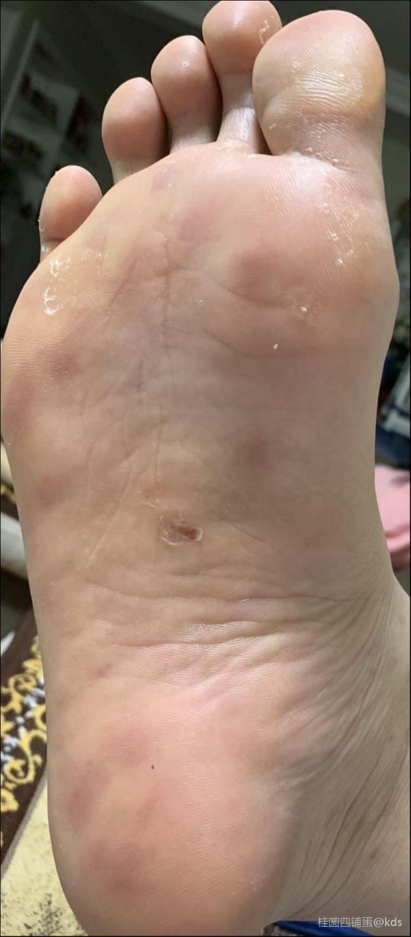 脚上的红斑是什么情况?