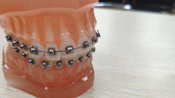 求助!有牙友认识这种球形牙套吗