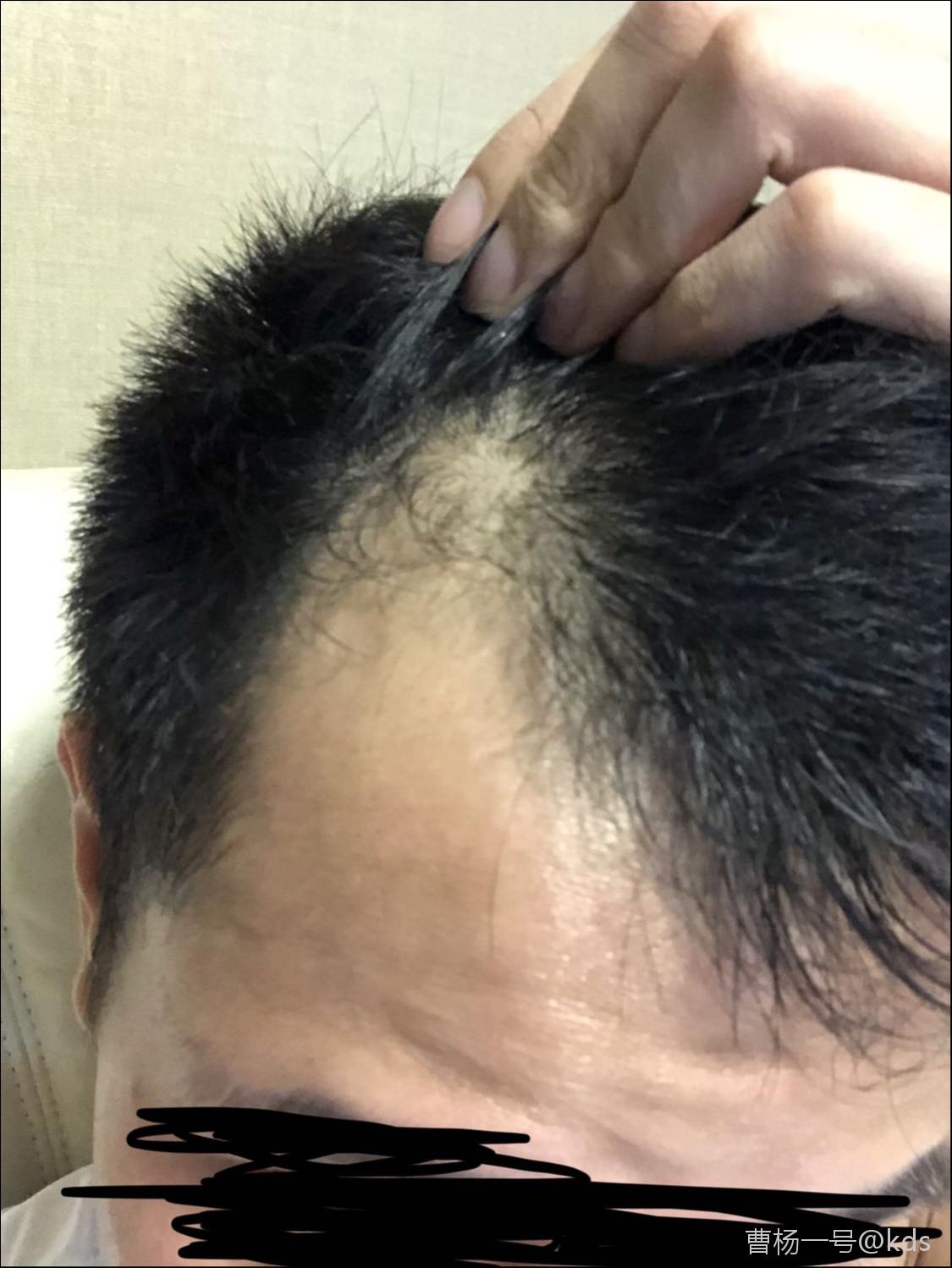 30岁,两额头发已经秃成这样,怎么办?