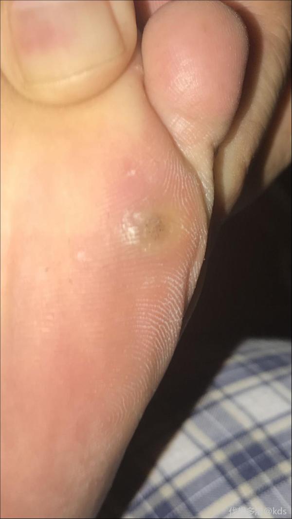 脚上长了个这个