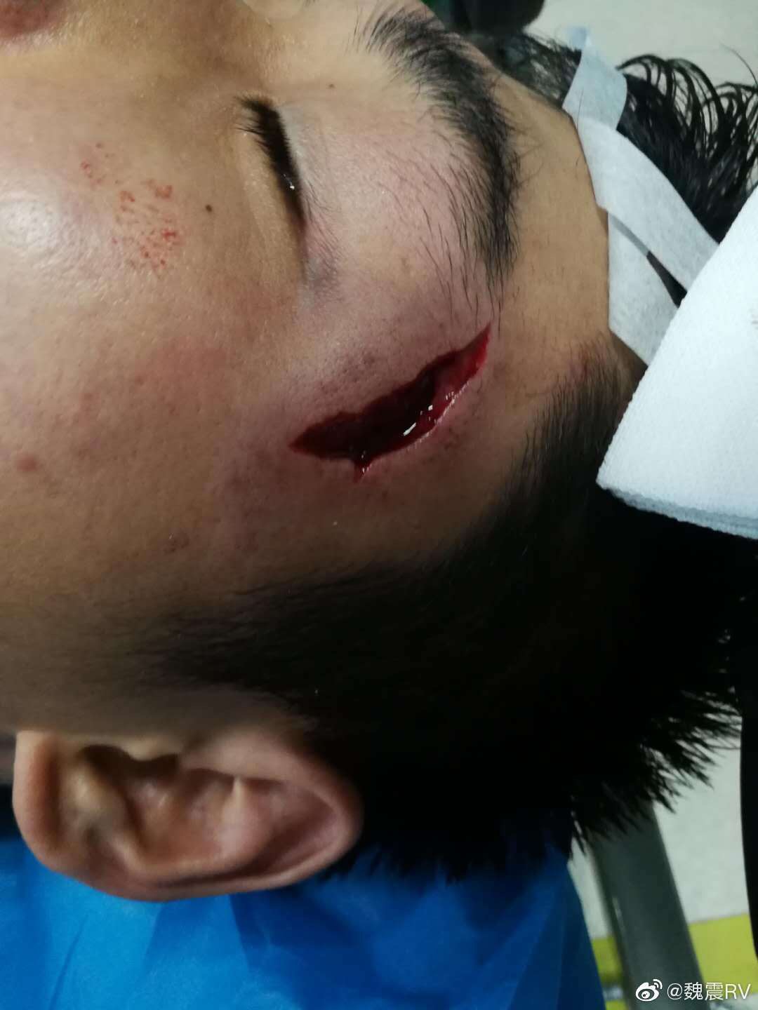 上港魏震昨天比赛被撞的伤口