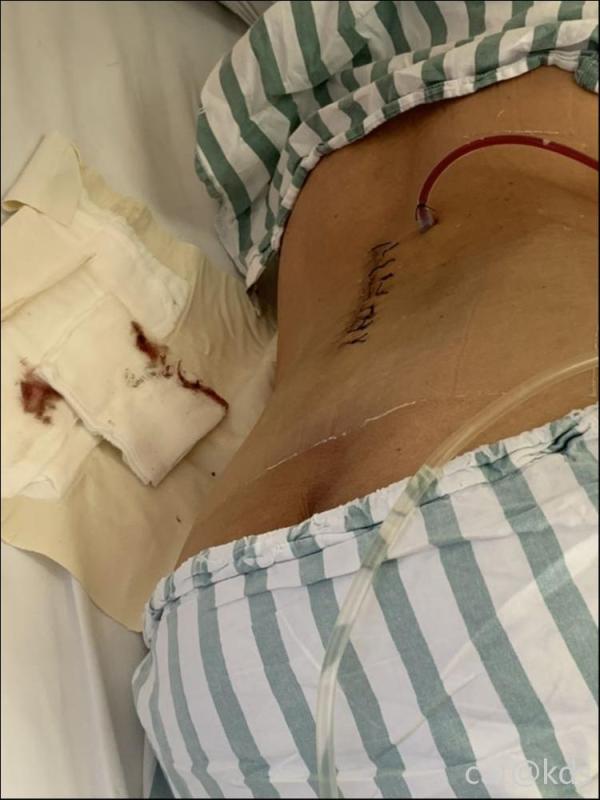 09:33为什么不管减压还是融合背后都有跟导管插入身体啊引用自#134楼