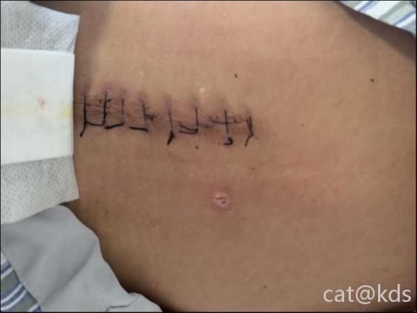 术后12天的伤口,医生说后天可以拆线了