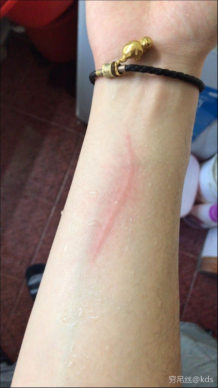 被猫抓伤,要不要打狂犬病疫苗