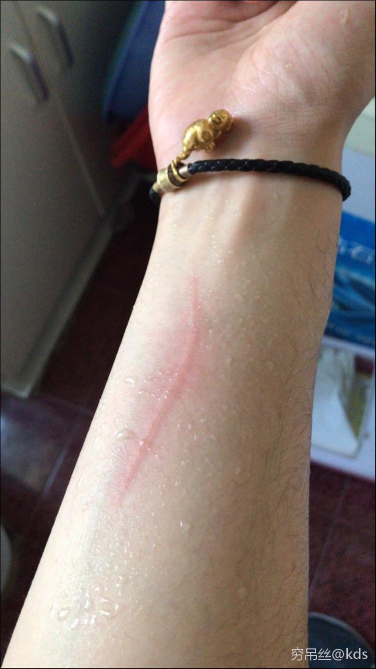 被猫抓伤,要不要打狂犬病疫苗